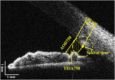 Identification of Peripheral Anterior Synechia by Corneal Deformation Using Air-Puff Dynamic Anterior Segment Optical Coherence Tomography